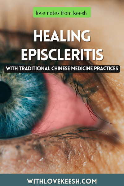 Healing Episcleritis with Traditional Chinese Medicine Practices